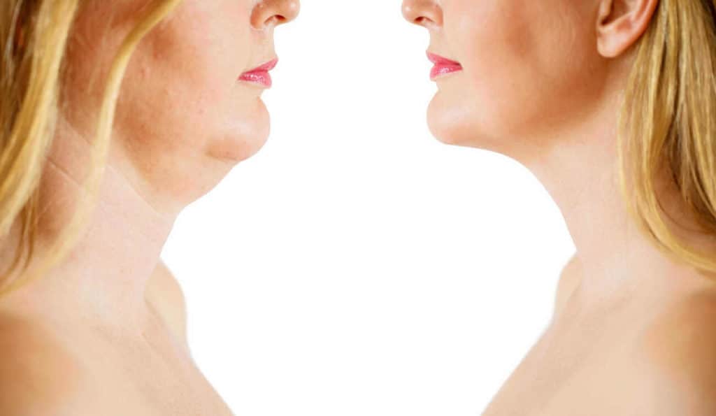 Double Chin treatment Malvern Wells before and after results