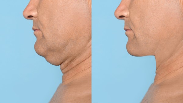 Which Non-Surgical Treatments Work Best for Jowls and Loose Skin Malvern Wells?