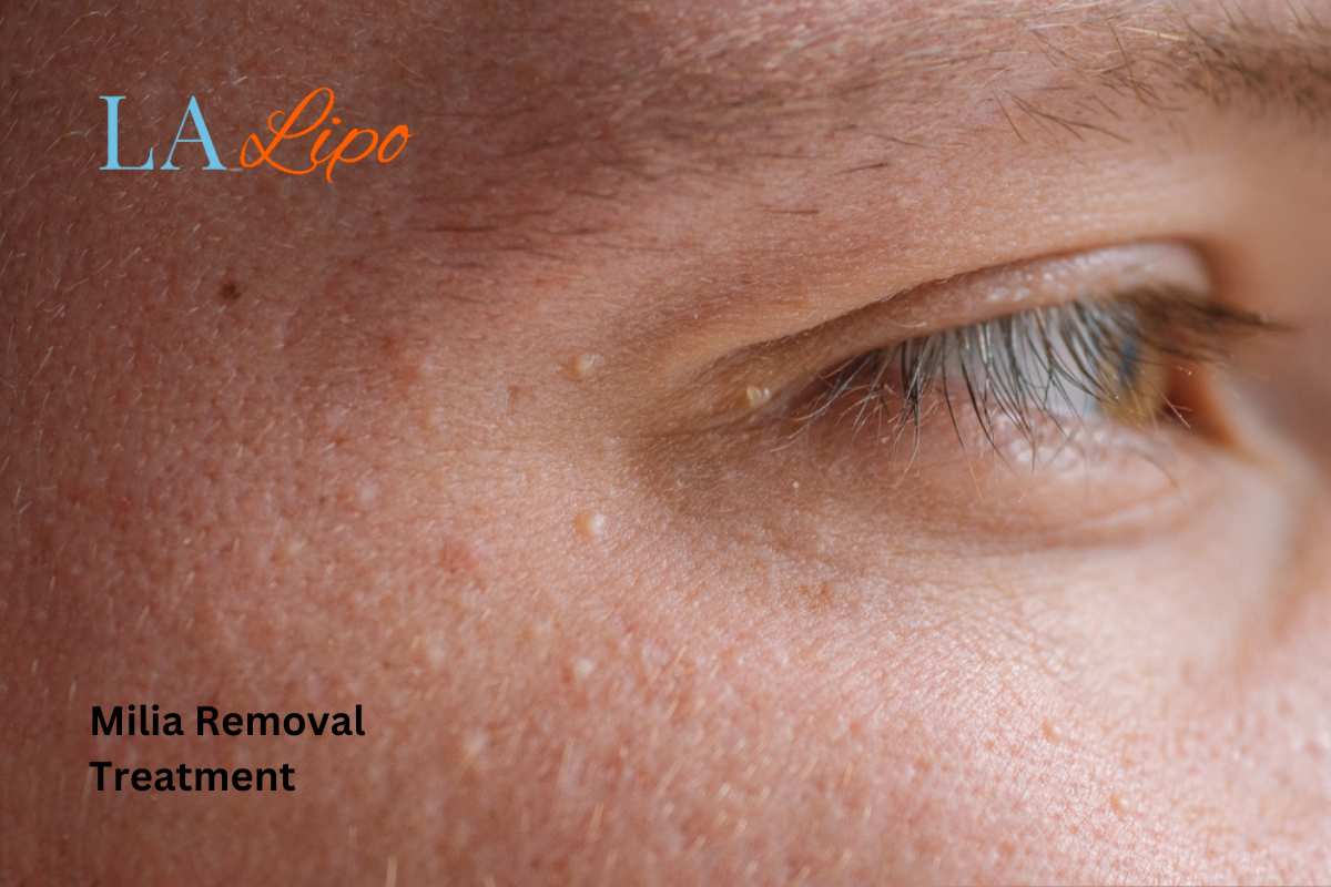 Cryopen Milia Removal: Is It the Easiest and Safest Option Malvern Wells?