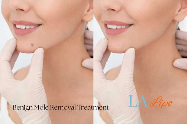 Before-and-after results following benign mole-removal treatment Malvern Wells