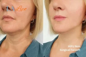 hi-fu for wrinkles Malvern Wells before and after results