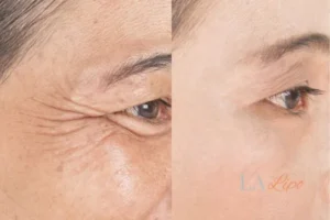 Before and after results of woman - HI-fu wrinkles reduction treatment Malvern Wells