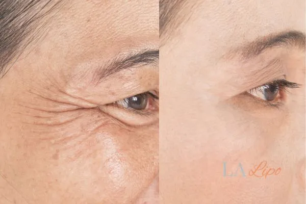 Before and after results of woman - HI-fu wrinkles reduction treatment Malvern Wells