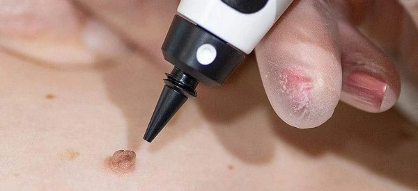 skin tag removal using cryopen Malvern Wells