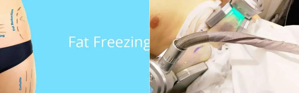 Fat freezing Malvern Wells on multiple areas of the body