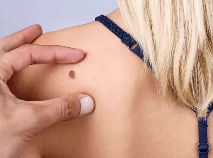 woman having mole removal Malvern Wells consultation before treatment.