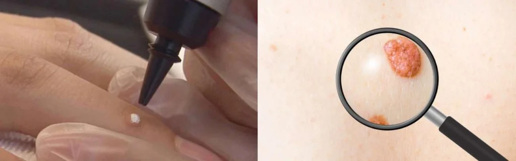 CryoPen practitioner Malvern Wells assessing a benign mole before treatment