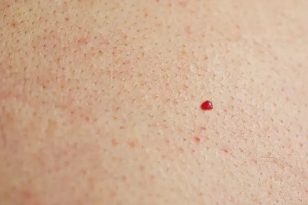 close up of a cherry angioma Malvern Wells