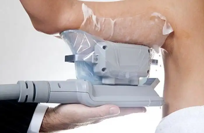 Picture of fat freezing Malvern Wells on the upper arms.