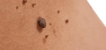 image of a skin tag Malvern Wells