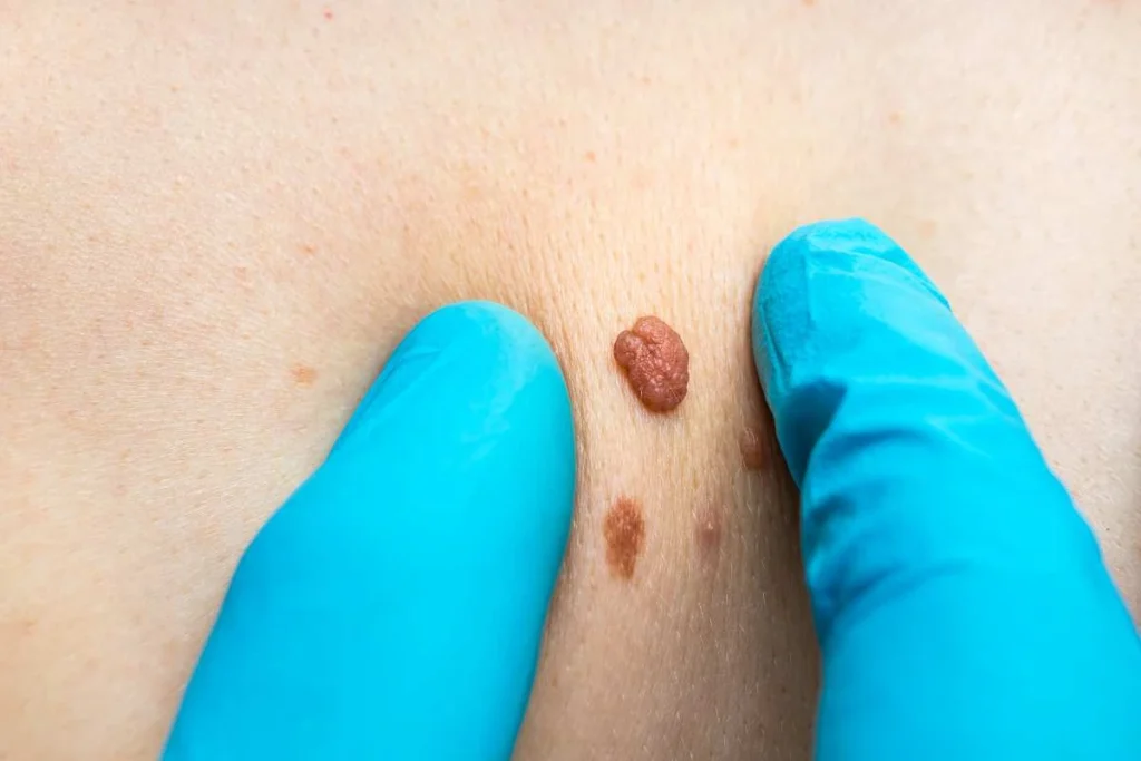 Consultant examining a skin tag Malvern Wells