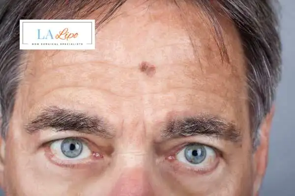 Solar Lentigo Removal Malvern Wells image of man with mark on his forehead