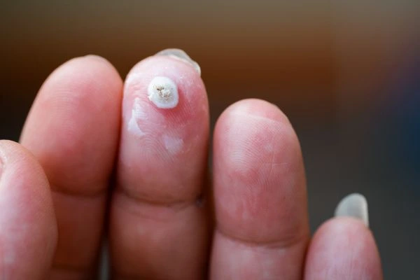 wart on person finger - cryotherapy to treat from LA LIPO Malvern Wells
