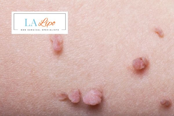 Does cryopen skin tag removal Malvern Wells hurt? Find out now call our team today!