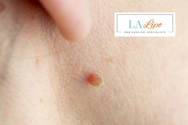Book skin tag removal Malvern Wells today speak to our team now!