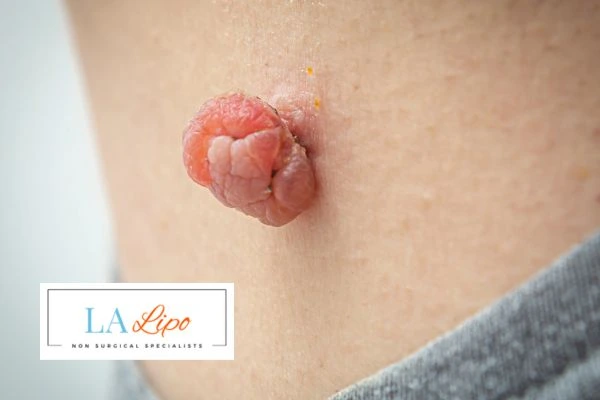 Interested in skin tag removal Malvern Wells? Concerned about the pain? Find out more today!
