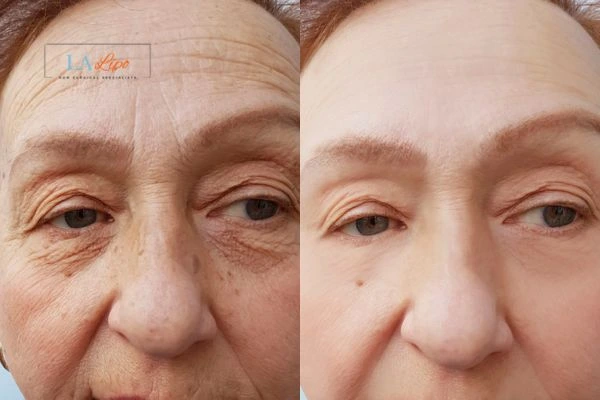 The powerful benefits of Morpheus8 Treatment Malvern Wells - Call Our team today!
