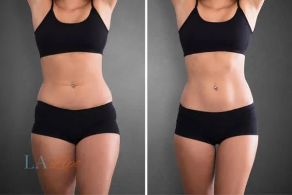 before and after results of non-surgical treatment to help a woman's body image and mental health Malvern Wells