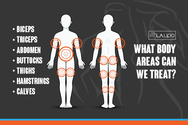 Diagram to show areas you can have LA-EMS Body Sculpting Treatment Malvern Wells