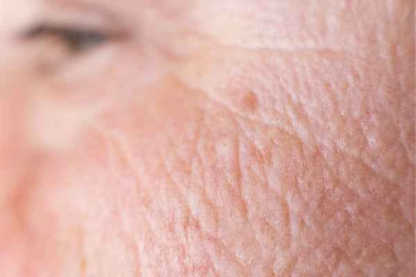 close up picture of a woman's face showing an age spot Malvern Wells