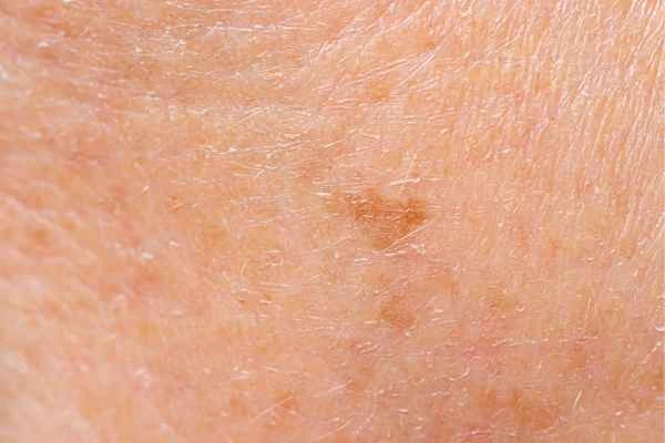 close up picture of age spots Malvern Wells