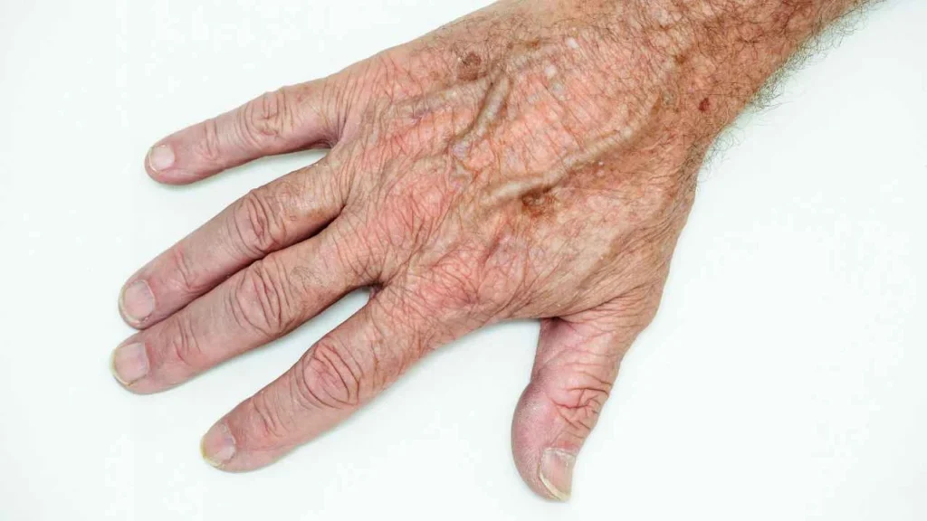 Male hand showing age spot Malvern Wells