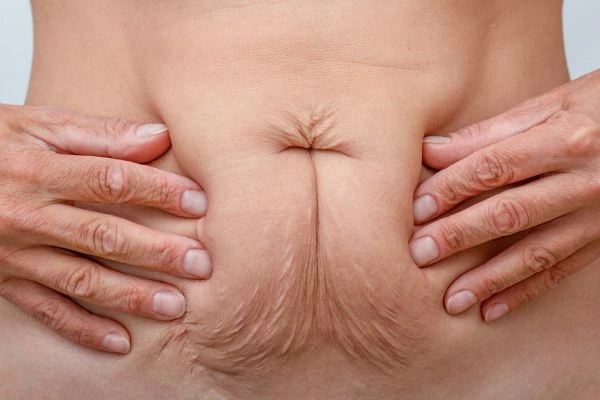 Image of a woman's stomach with loose skin - example of skin tightening Malvern Wells options