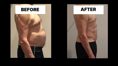 What Symptoms Can Diastasis Recti Cause in Men? Weak Core, Back Pain and Poor Posture Malvern Wells